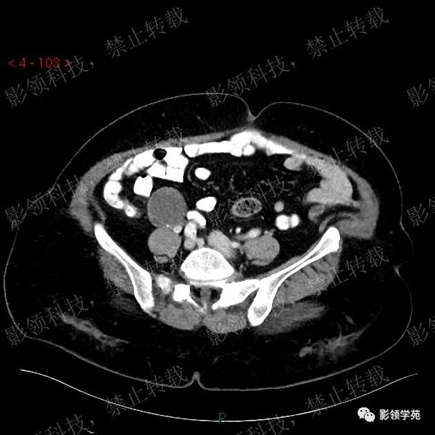 影像PPT - 【病例】阑尾粘液囊肿1例CT-2 影像PPT - 【病例】阑尾粘液囊肿1例CT-2