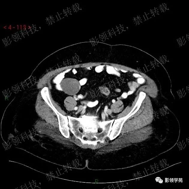影像PPT - 【病例】阑尾粘液囊肿1例CT-3 影像PPT - 【病例】阑尾粘液囊肿1例CT-3