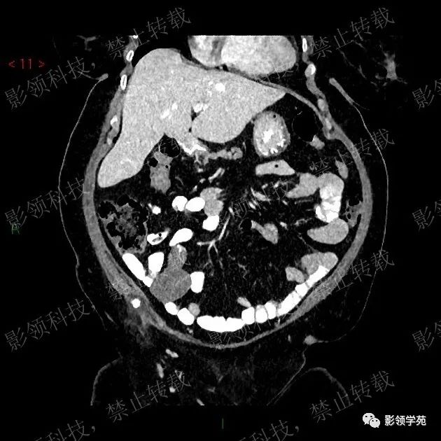 影像PPT - 【病例】阑尾粘液囊肿1例CT-4 影像PPT - 【病例】阑尾粘液囊肿1例CT-4
