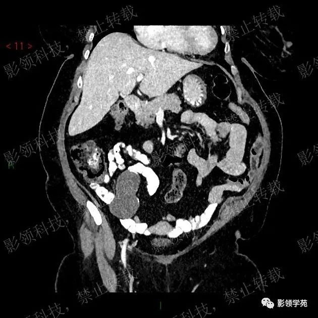 影像PPT - 【病例】阑尾粘液囊肿1例CT-5 影像PPT - 【病例】阑尾粘液囊肿1例CT-5