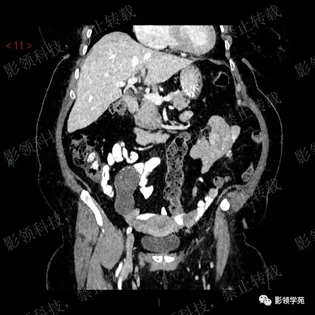 影像PPT - 【病例】阑尾粘液囊肿1例CT-6 影像PPT - 【病例】阑尾粘液囊肿1例CT-6