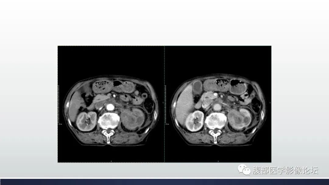 影像PPT - 【病例】肾脏浸润性尿路上皮癌2例CT-7