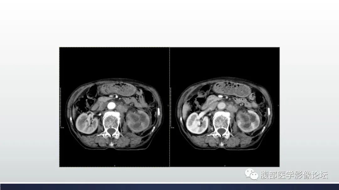 影像PPT - 【病例】肾脏浸润性尿路上皮癌2例CT-9