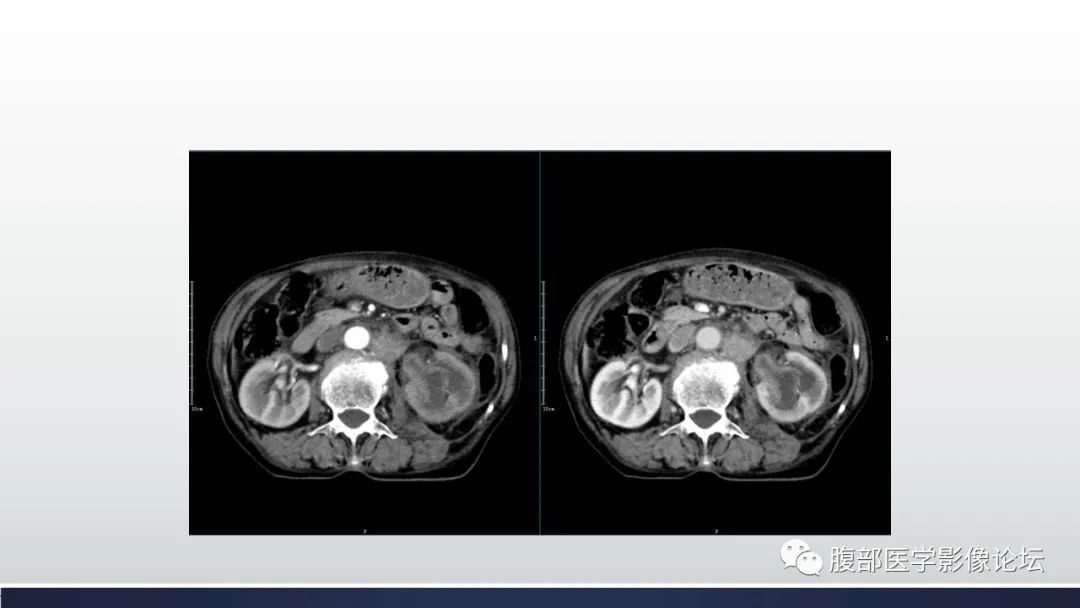 影像PPT - 【病例】肾脏浸润性尿路上皮癌2例CT-10