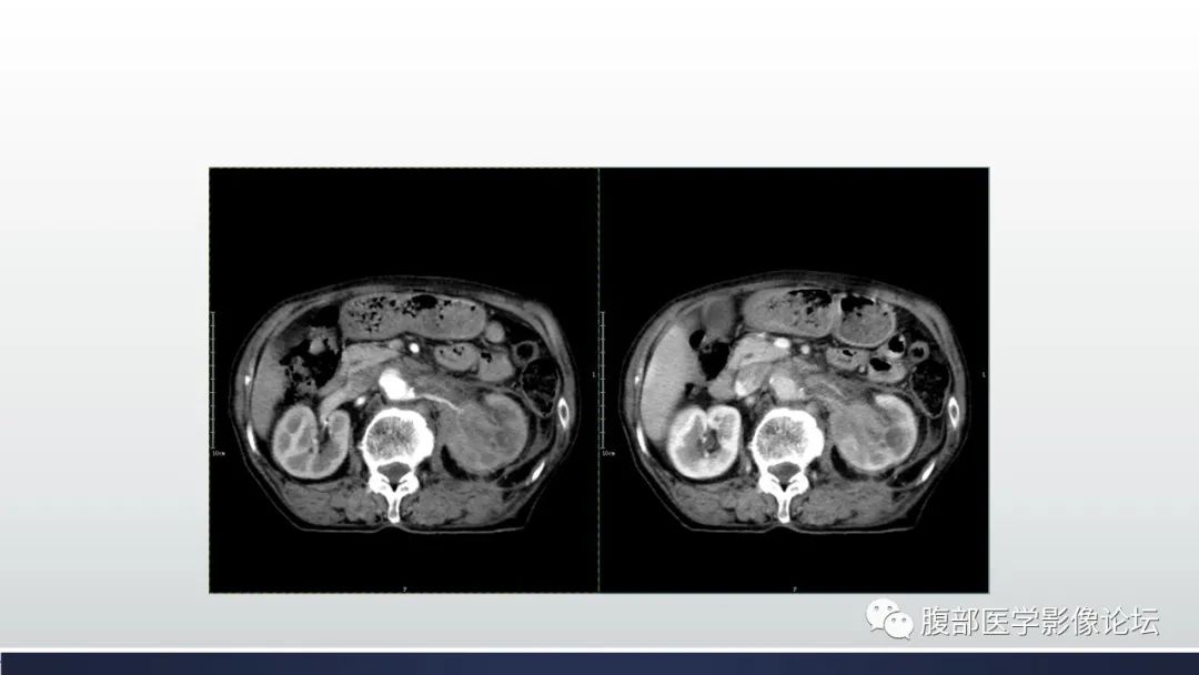 影像PPT - 【病例】肾脏浸润性尿路上皮癌2例CT-8
