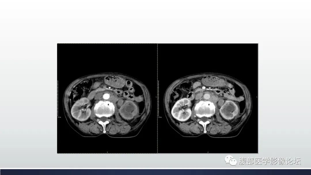 影像PPT - 【病例】肾脏浸润性尿路上皮癌2例CT-11