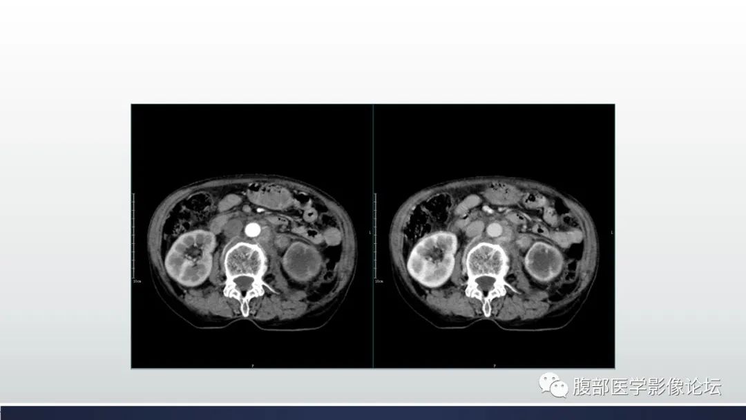 影像PPT - 【病例】肾脏浸润性尿路上皮癌2例CT-12