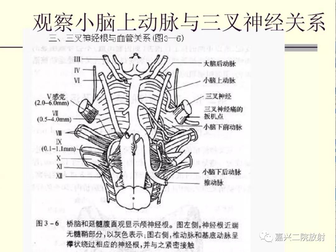 影像PPT - 【PPT】3D-TOF-MRA在三叉神经面肌抽搐综合征中的应用-5