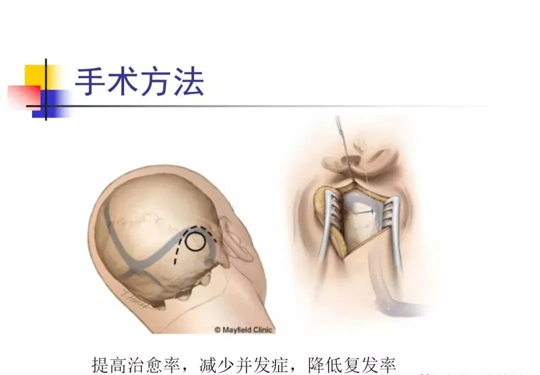 影像PPT - 【PPT】3D-TOF-MRA在三叉神经面肌抽搐综合征中的应用-13