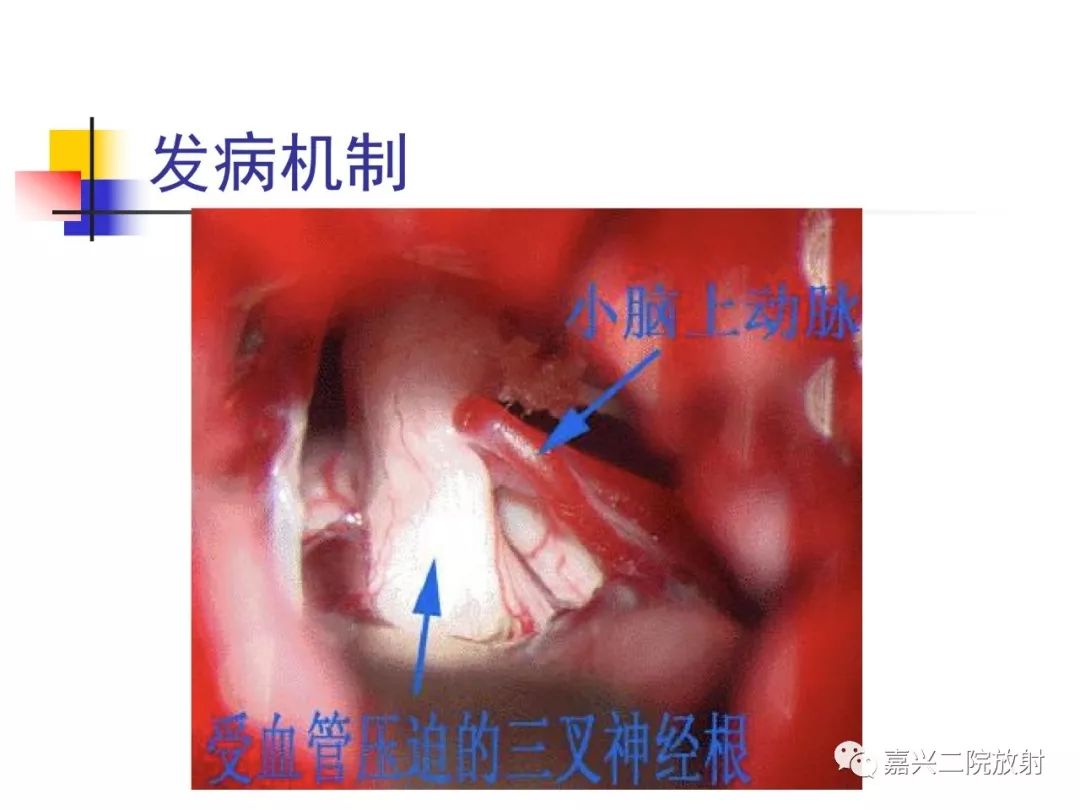 影像PPT - 【PPT】3D-TOF-MRA在三叉神经面肌抽搐综合征中的应用-10
