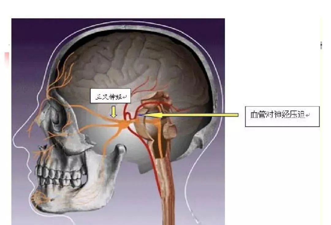 影像PPT - 【PPT】3D-TOF-MRA在三叉神经面肌抽搐综合征中的应用-9