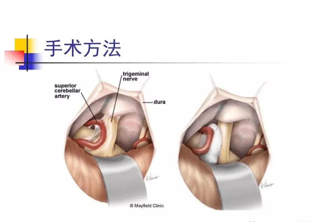 影像PPT - 【PPT】3D-TOF-MRA在三叉神经面肌抽搐综合征中的应用-16