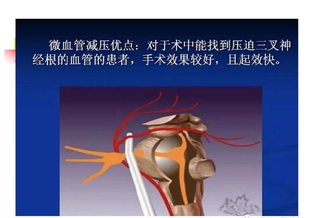 影像PPT - 【PPT】3D-TOF-MRA在三叉神经面肌抽搐综合征中的应用-18