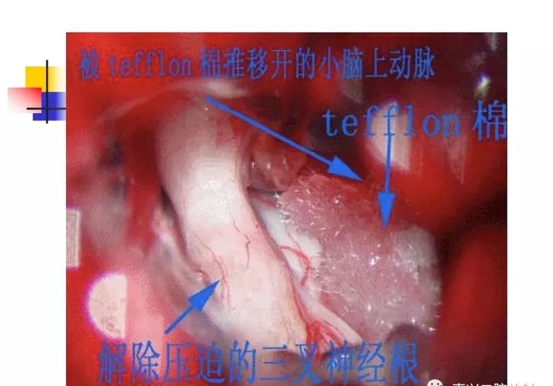 影像PPT - 【PPT】3D-TOF-MRA在三叉神经面肌抽搐综合征中的应用-17