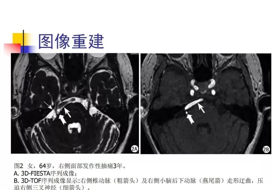 影像PPT - 【PPT】3D-TOF-MRA在三叉神经面肌抽搐综合征中的应用-22