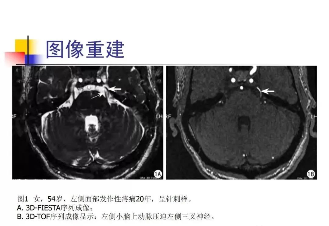影像PPT - 【PPT】3D-TOF-MRA在三叉神经面肌抽搐综合征中的应用-21