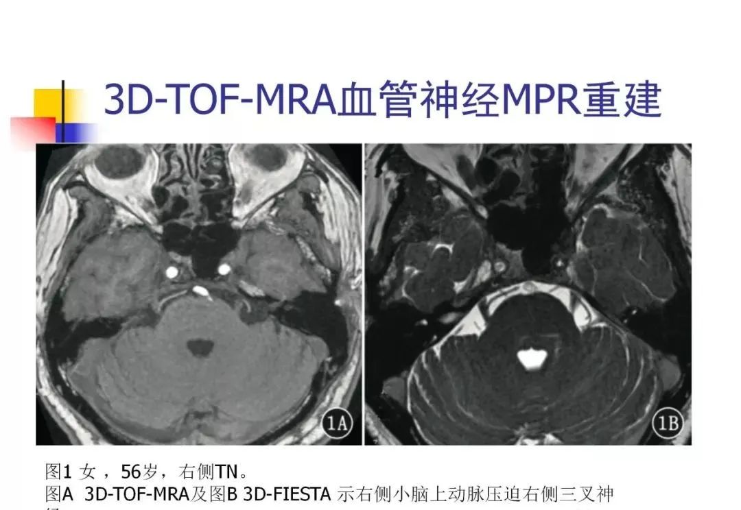 影像PPT - 【PPT】3D-TOF-MRA在三叉神经面肌抽搐综合征中的应用-24
