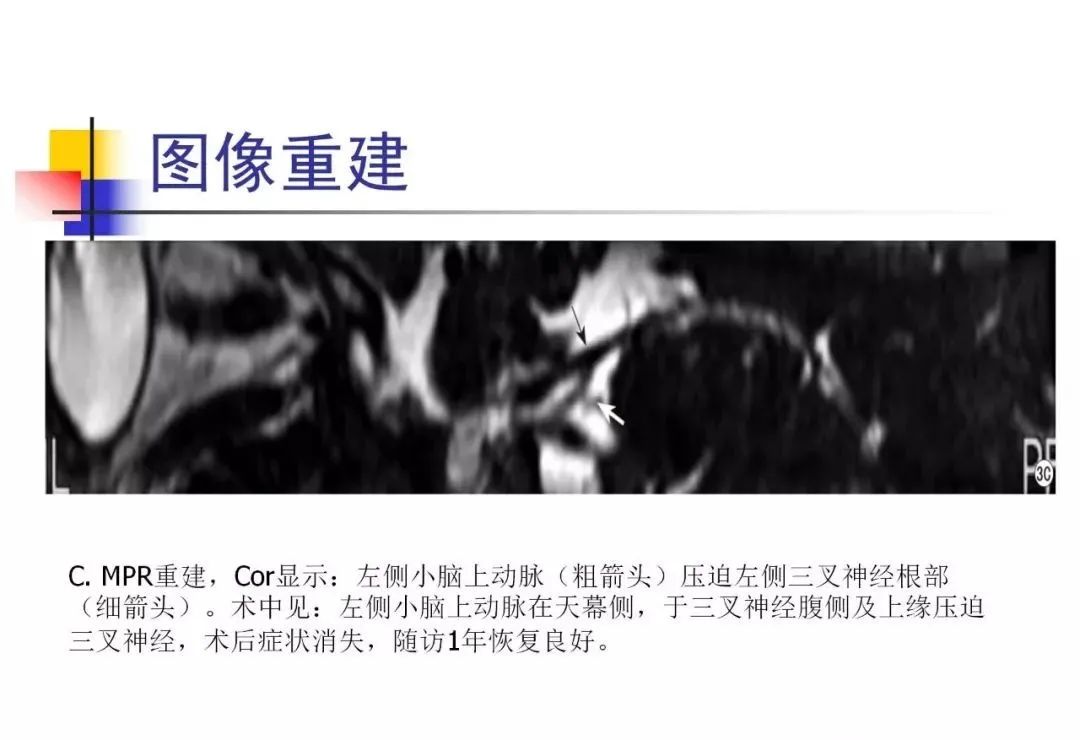 影像PPT - 【PPT】3D-TOF-MRA在三叉神经面肌抽搐综合征中的应用-23