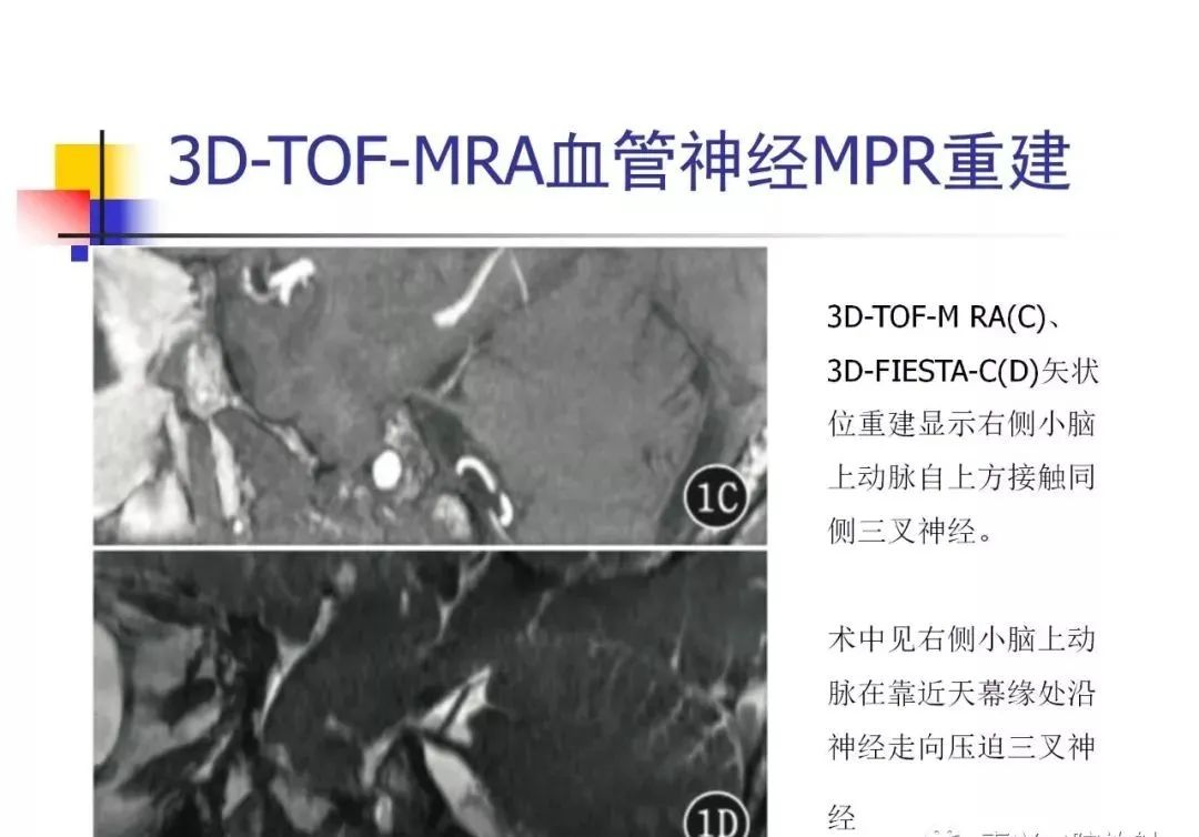 影像PPT - 【PPT】3D-TOF-MRA在三叉神经面肌抽搐综合征中的应用-25