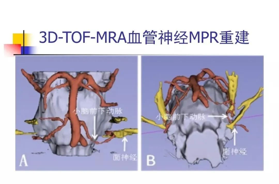 影像PPT - 【PPT】3D-TOF-MRA在三叉神经面肌抽搐综合征中的应用-26