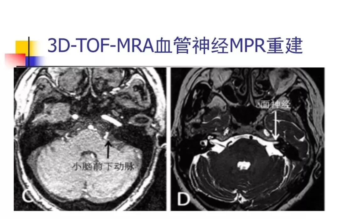 影像PPT - 【PPT】3D-TOF-MRA在三叉神经面肌抽搐综合征中的应用-27