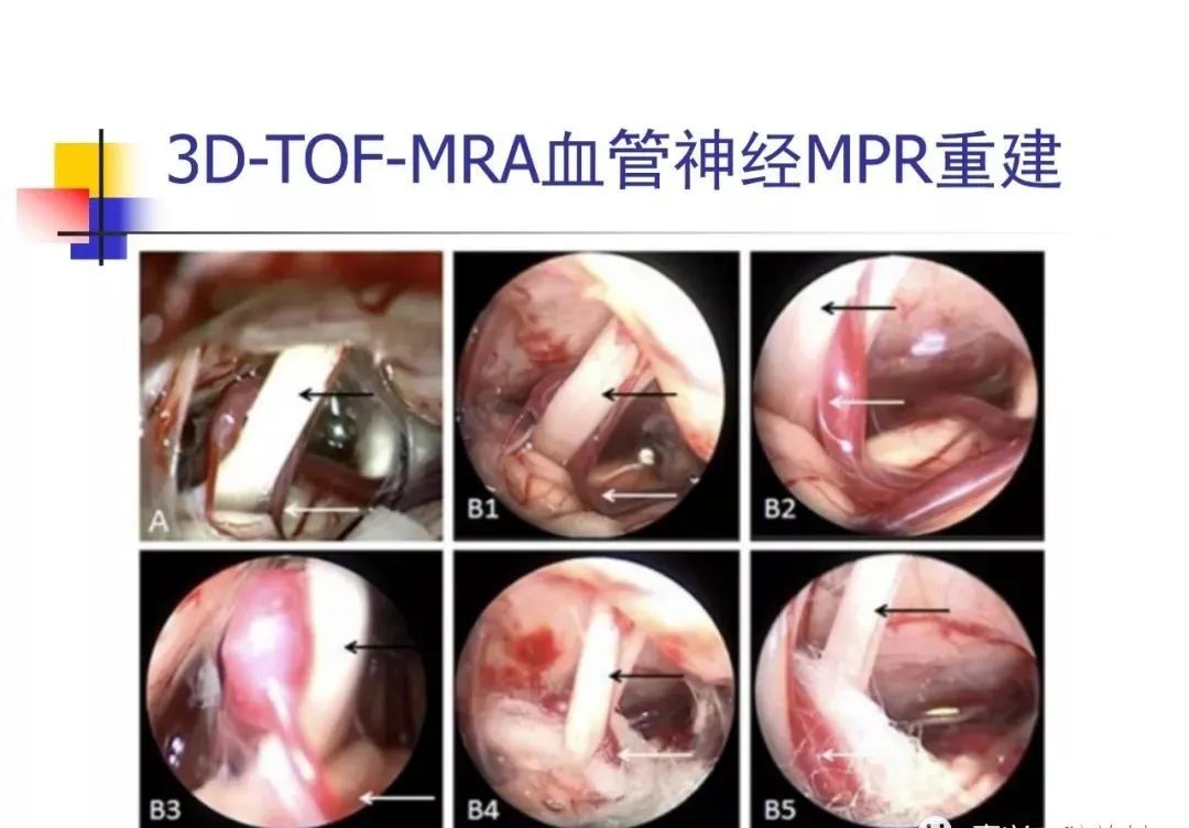 影像PPT - 【PPT】3D-TOF-MRA在三叉神经面肌抽搐综合征中的应用-28
