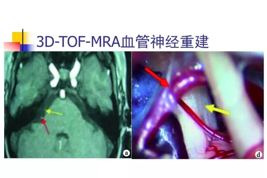 影像PPT - 【PPT】3D-TOF-MRA在三叉神经面肌抽搐综合征中的应用-35