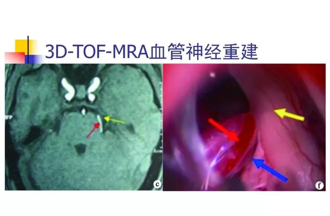 影像PPT - 【PPT】3D-TOF-MRA在三叉神经面肌抽搐综合征中的应用-37