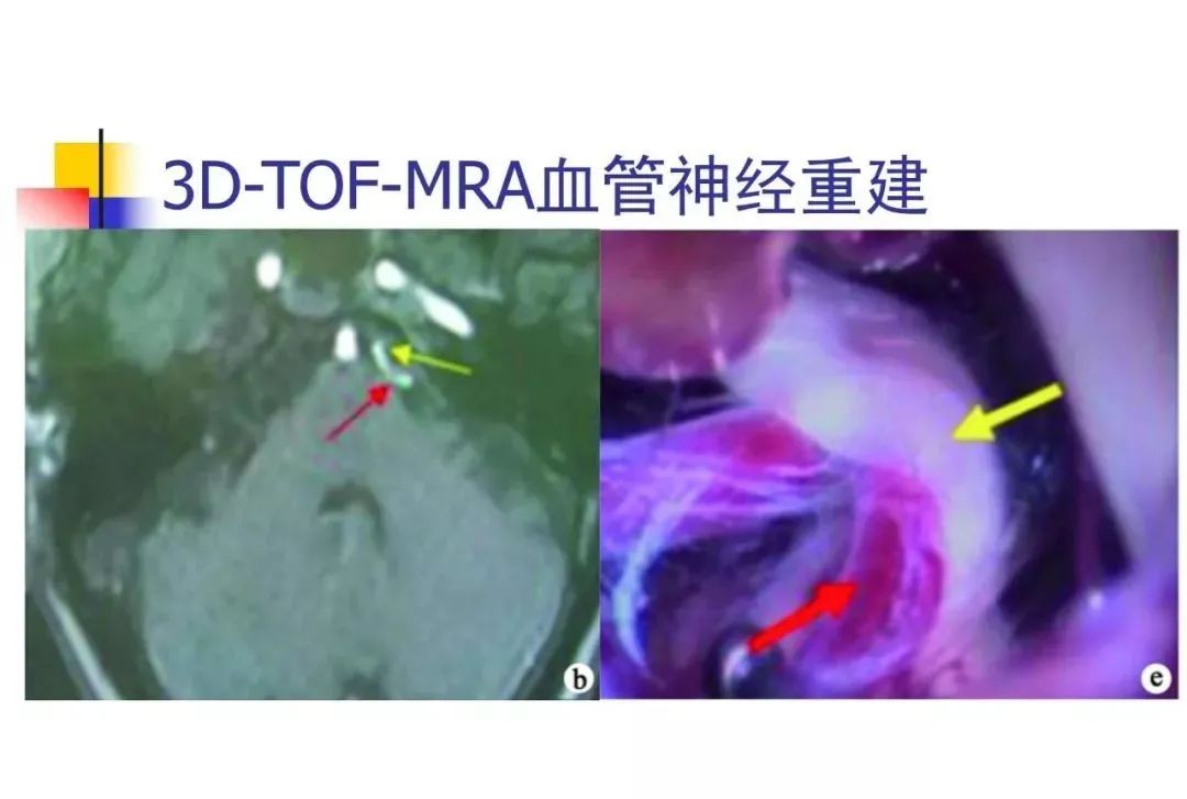 影像PPT - 【PPT】3D-TOF-MRA在三叉神经面肌抽搐综合征中的应用-36