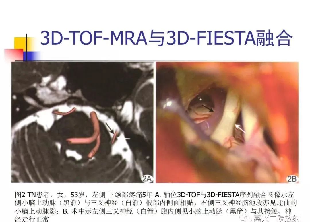 影像PPT - 【PPT】3D-TOF-MRA在三叉神经面肌抽搐综合征中的应用-41