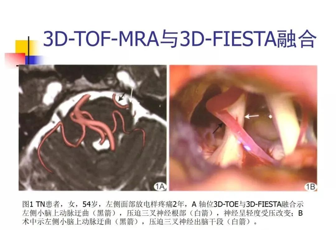 影像PPT - 【PPT】3D-TOF-MRA在三叉神经面肌抽搐综合征中的应用-40