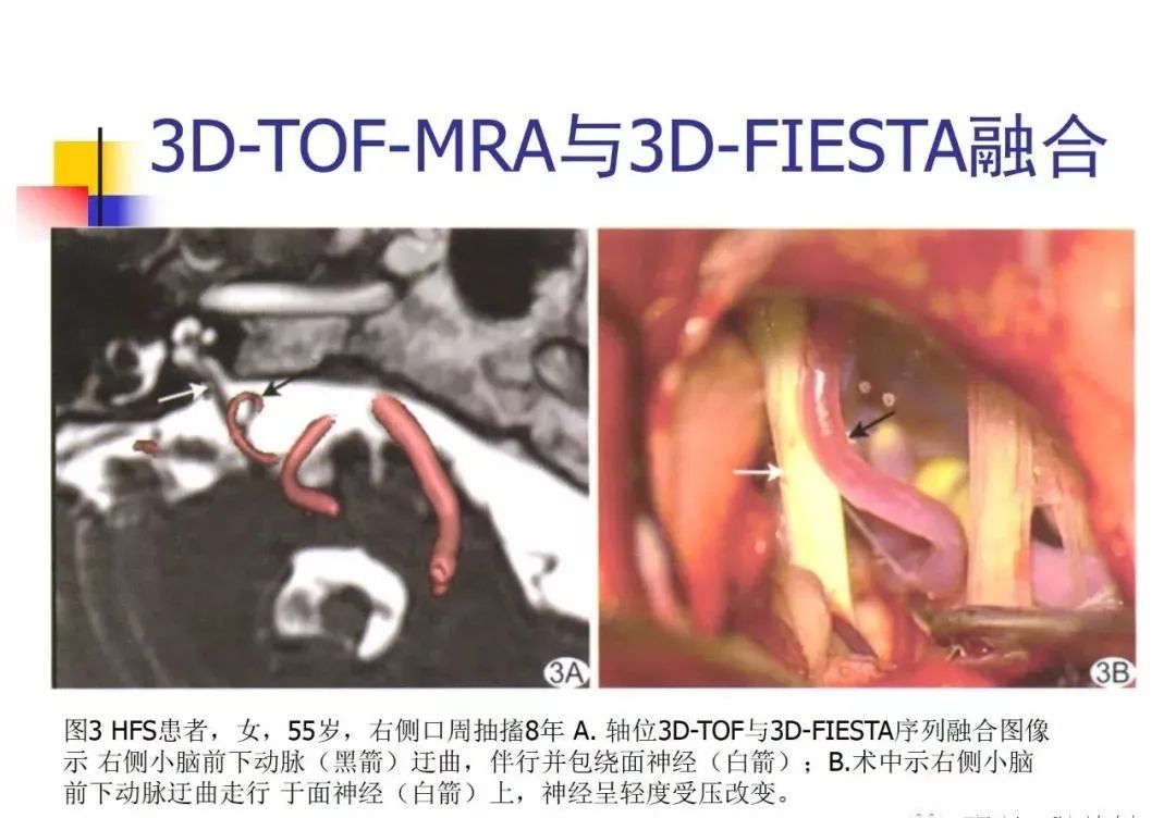 影像PPT - 【PPT】3D-TOF-MRA在三叉神经面肌抽搐综合征中的应用-42