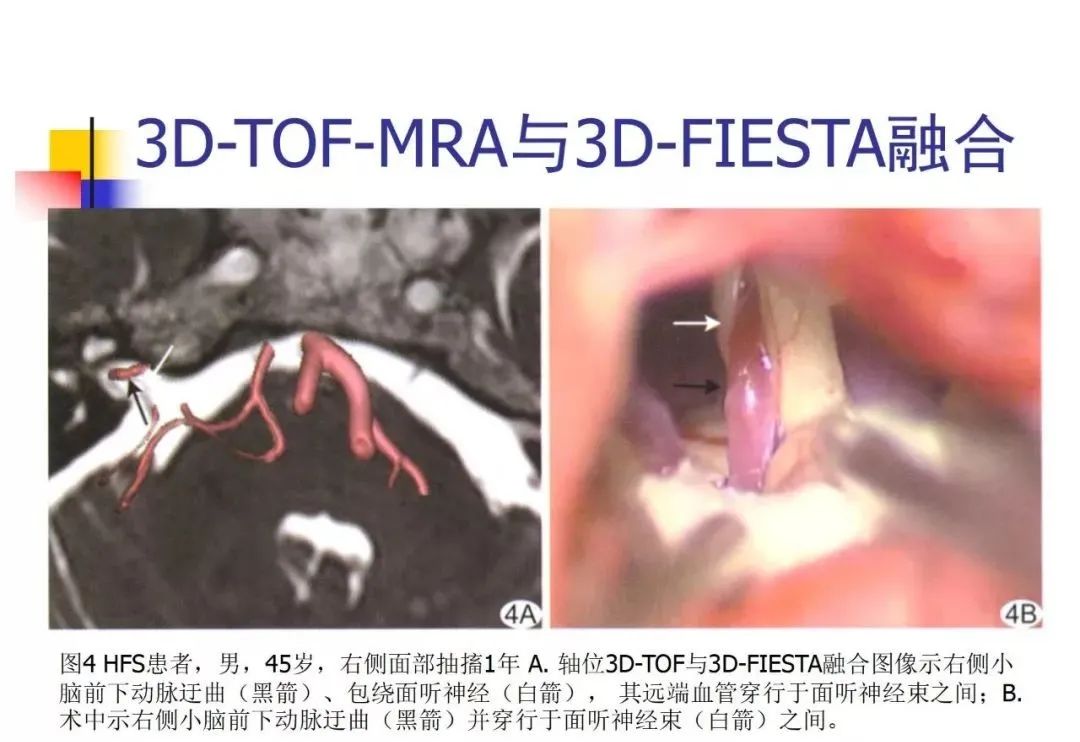 影像PPT - 【PPT】3D-TOF-MRA在三叉神经面肌抽搐综合征中的应用-43