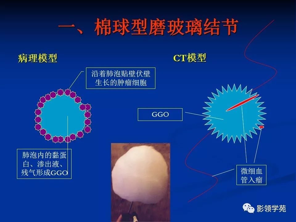 影像PPT - 【PPT】肺腺癌的十类形态学分型-2