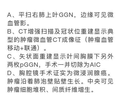 影像PPT - 【PPT】肺腺癌的十类形态学分型-6