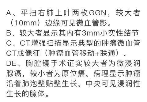 影像PPT - 【PPT】肺腺癌的十类形态学分型-10