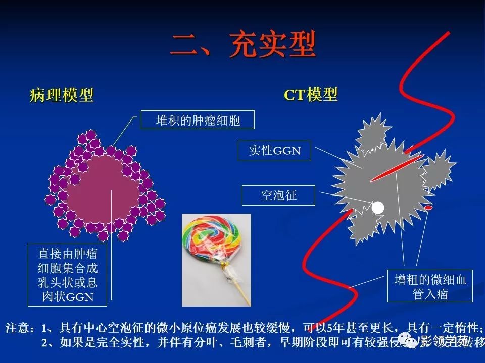 影像PPT - 【PPT】肺腺癌的十类形态学分型-12