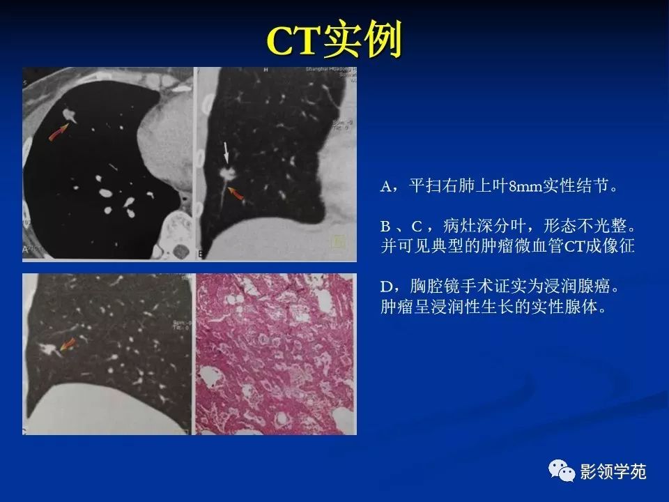 影像PPT - 【PPT】肺腺癌的十类形态学分型-14