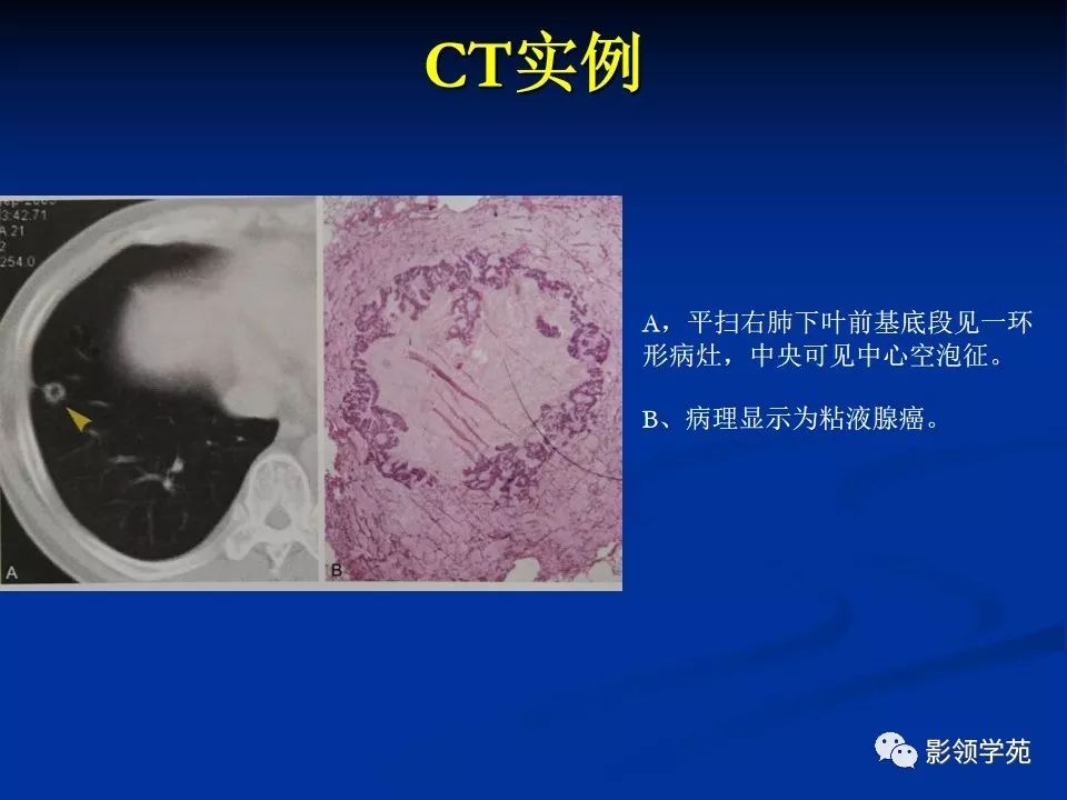 影像PPT - 【PPT】肺腺癌的十类形态学分型-13