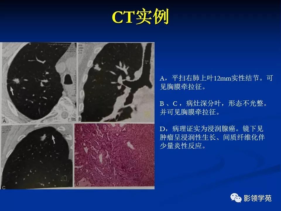 影像PPT - 【PPT】肺腺癌的十类形态学分型-15
