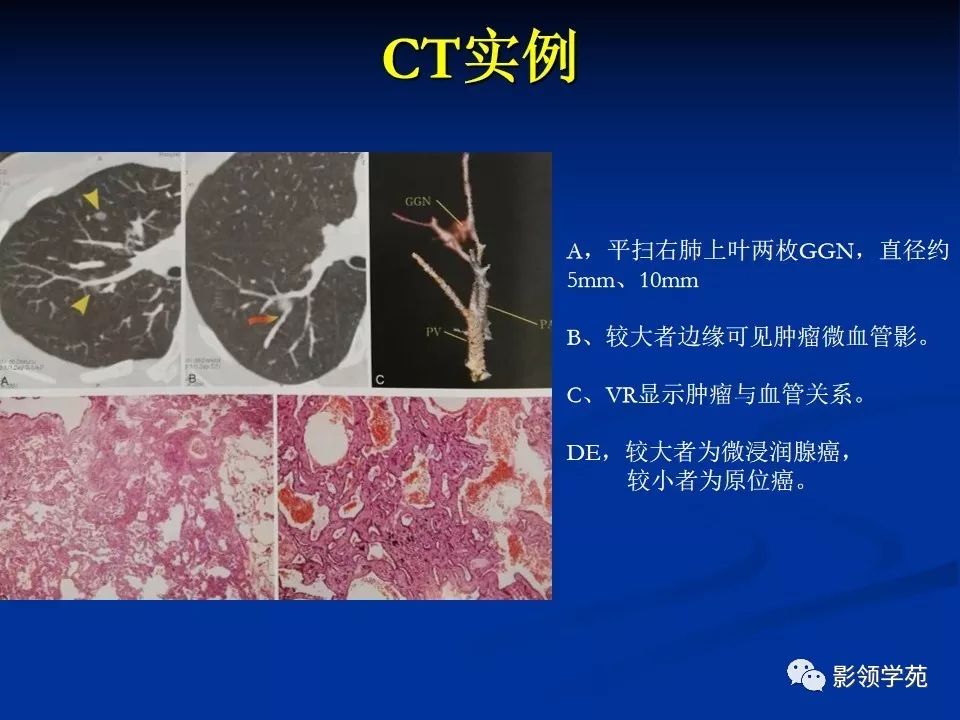 影像PPT - 【PPT】肺腺癌的十类形态学分型-17