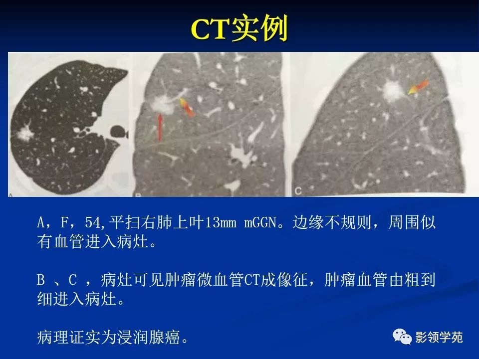 影像PPT - 【PPT】肺腺癌的十类形态学分型-16