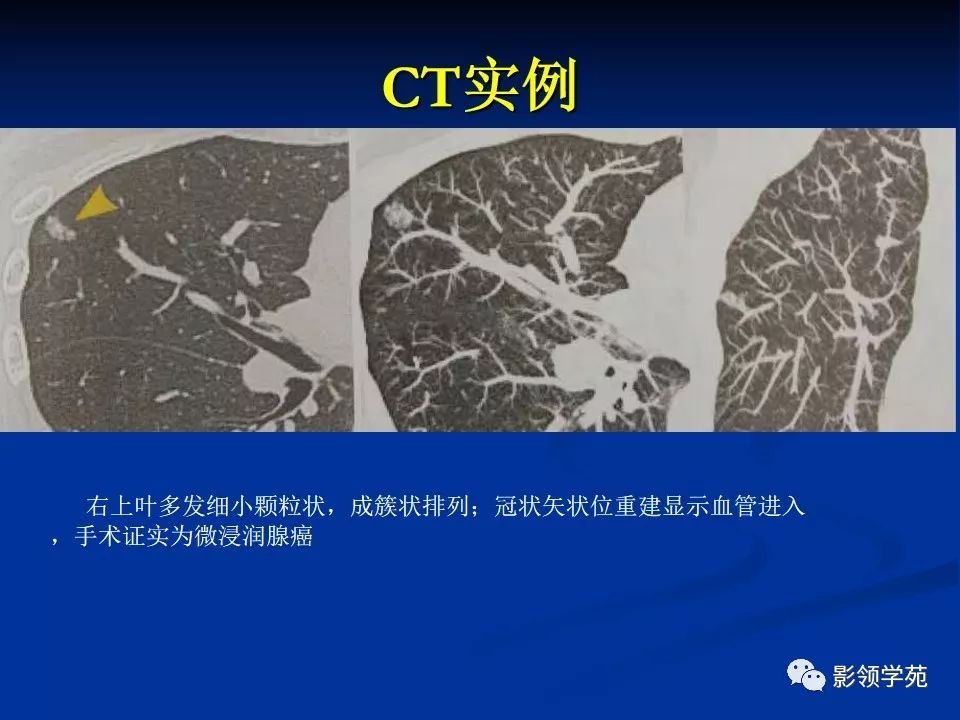 影像PPT - 【PPT】肺腺癌的十类形态学分型-21