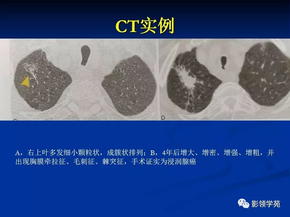 影像PPT - 【PPT】肺腺癌的十类形态学分型-20