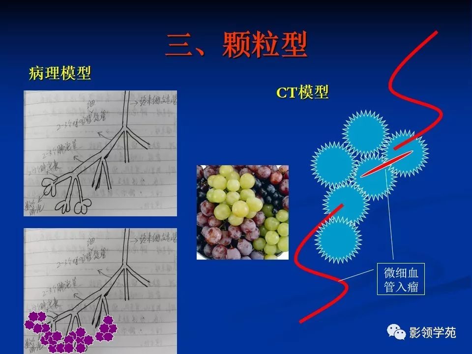 影像PPT - 【PPT】肺腺癌的十类形态学分型-18