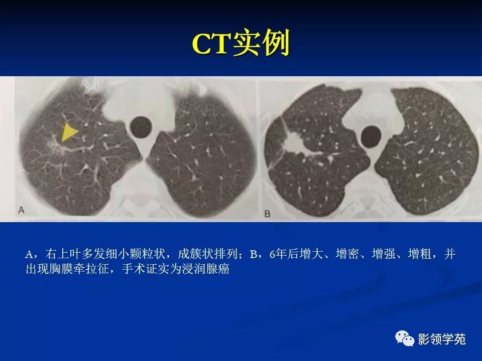 影像PPT - 【PPT】肺腺癌的十类形态学分型-19