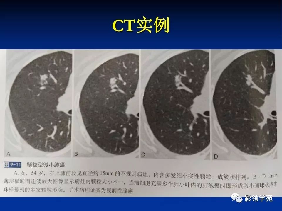 影像PPT - 【PPT】肺腺癌的十类形态学分型-22