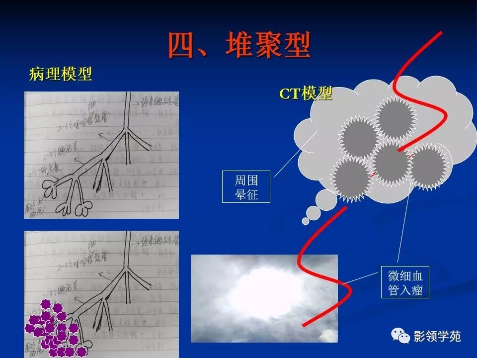 影像PPT - 【PPT】肺腺癌的十类形态学分型-23