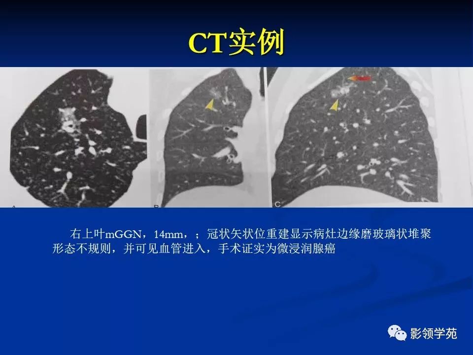 影像PPT - 【PPT】肺腺癌的十类形态学分型-24