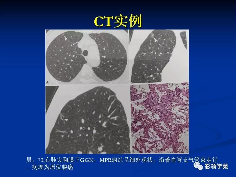 影像PPT - 【PPT】肺腺癌的十类形态学分型-29
